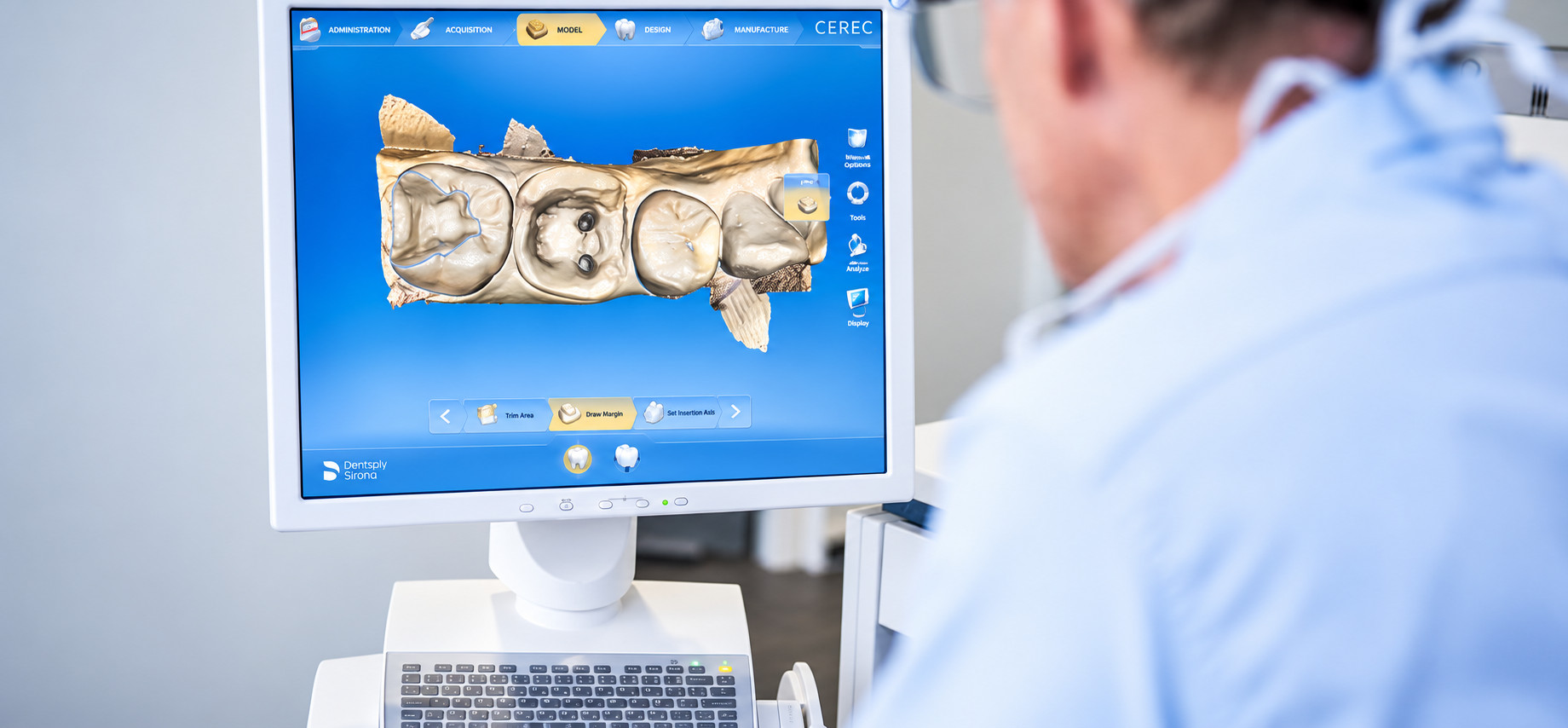 Écran du Cerec affichant une empreinte numérique